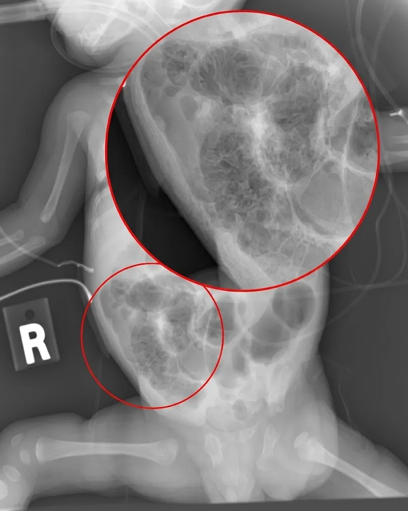 enterocolitis necrosante